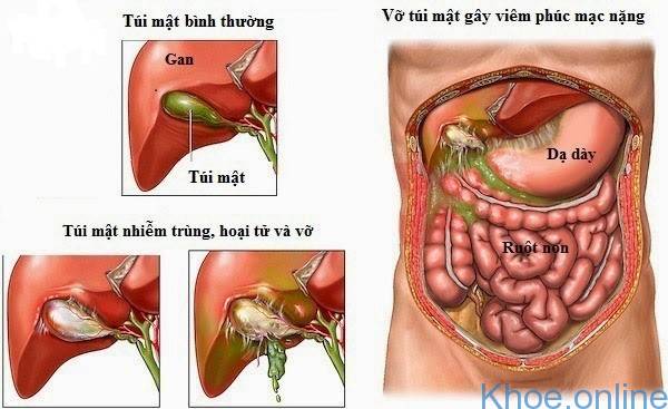 Viêm phúc mạc - Hình ảnh minh họa